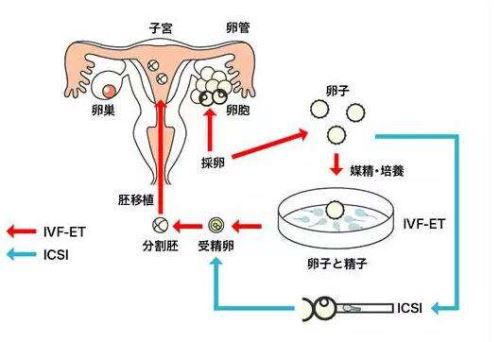 试管婴儿助孕