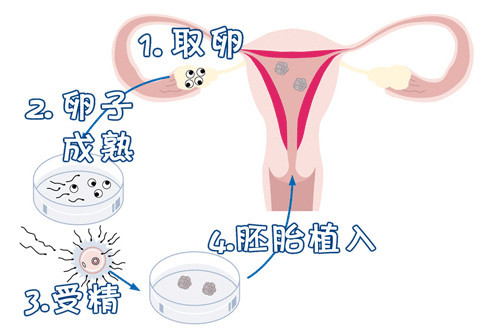 人工助孕方案
