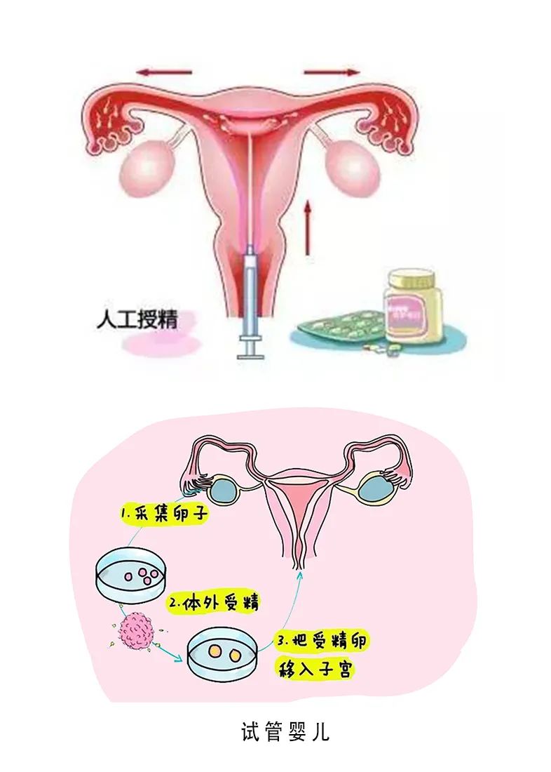 人工助孕费用
