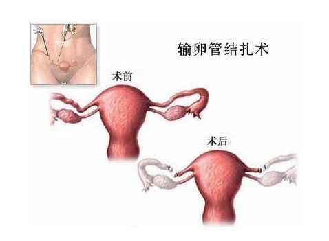 试管婴儿三代